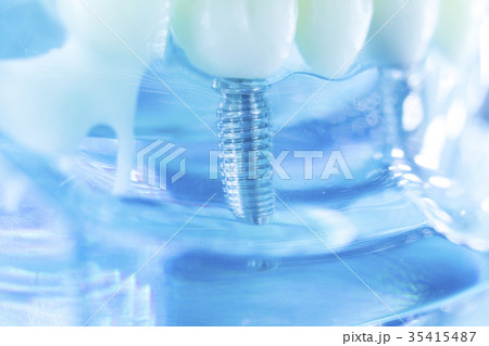 Dental titanium tooth implant Dental titanium tooth implant 35415487