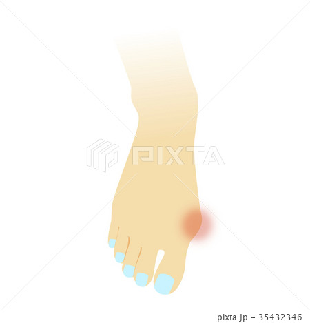 外反母趾 外反母趾 35432346