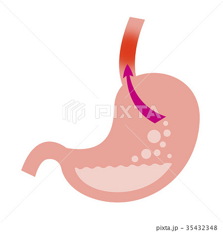 逆流性食道炎 逆流性食道炎 35432348