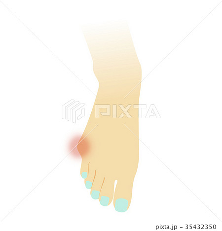 内反小趾 35432350