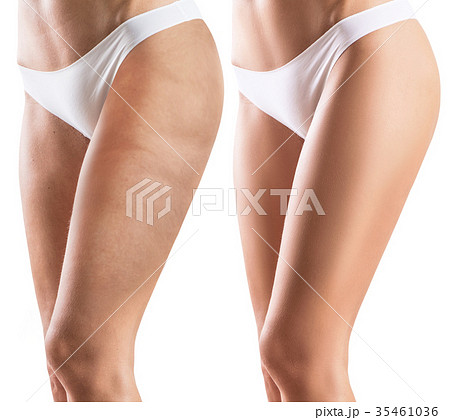 Woman legs before and after treatment skin. Woman legs before and after treatment skin. 35461036