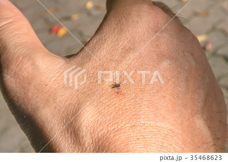 虫刺され 35468623