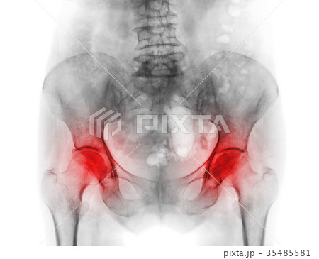 pelvis of osteoporosis patient and arthritis hip pelvis of osteoporosis patient and arthritis hip 35485581