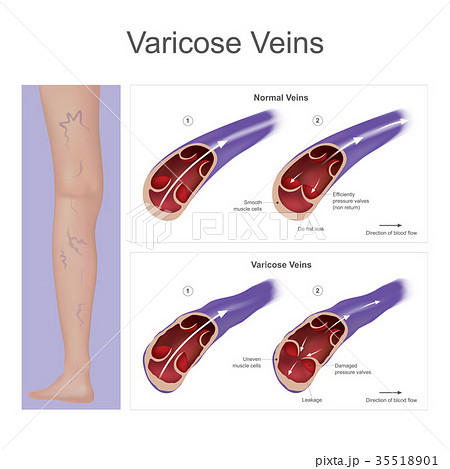 Varicose veins. Varicose veins. 35518901