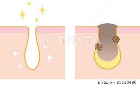 毛穴　ビフォーアフター 35530490