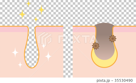 Pore Before After 35530490