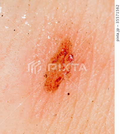 Wound on the skin of a person Wound on the skin of a person 35571562