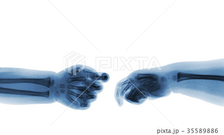 Baby 's hands x-ray and blank area at upper side . Baby 's hands x-ray and blank area at upper side . 35589886