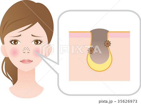 鼻の黒ずみ 鼻の黒ずみ 35626973