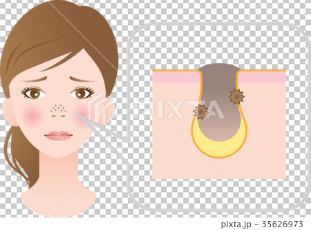 鼻の黒ずみ 鼻の黒ずみ 35626973