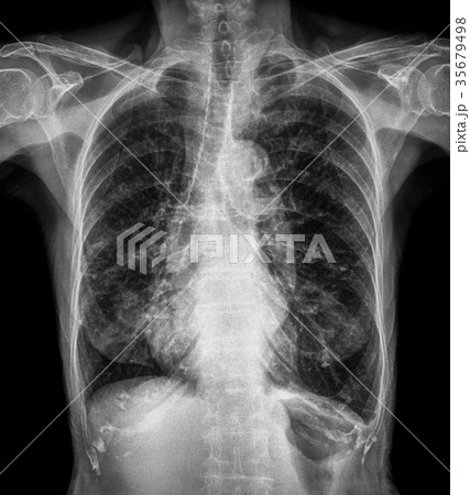 Normal chest X-ray of old patient .  35679498