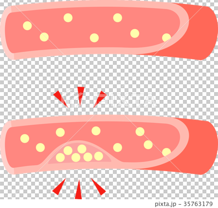 コレステロールが溜まって狭まった血管 35763179