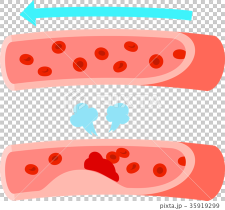 正常な血管と血栓ができた血管 35919299