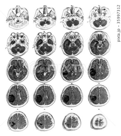 MRI brain show Brain tumor at right parietal lobe 35997312
