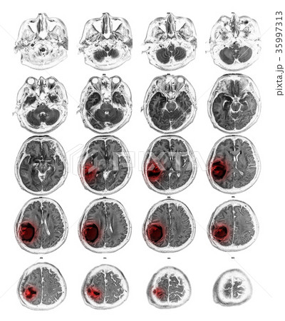 MRI brain show Brain tumor at right parietal lobe MRI brain show Brain tumor at right parietal lobe 35997313