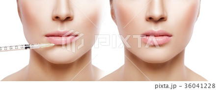 woman getting injection on lips. 36041228