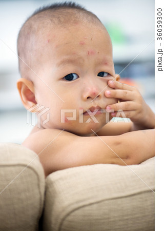 Baby boy with chicken pox at home 36059300
