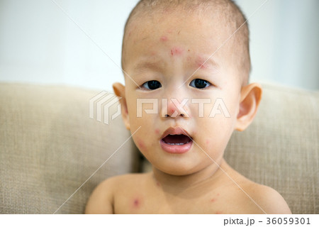 Asian baby boy with chicken pox 36059301