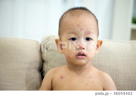 Baby boy with chicken pox on couch 36059302