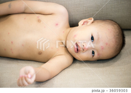 Baby boy with chicken pox lying on sofa 36059303