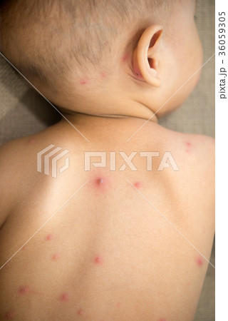 Baby back with chicken pox 36059305