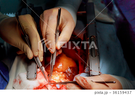 Surgeon during an operation on the open heart Surgeon during an operation on the open heart 36159437