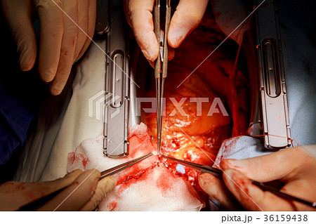 Surgeon hands are tying a knot during Surgeon hands are tying a knot during 36159438