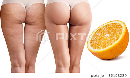 Female buttocks before and after treatment. 36198229
