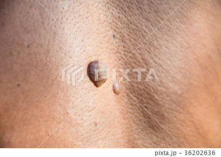 Mole on the skin of the body on human Mole on the skin of the body on human 36202636