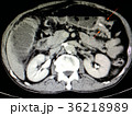 CT film of a patient's abdomen 36218989