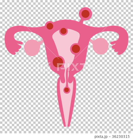 子宮筋腫（赤）　病気　イラスト 36230315