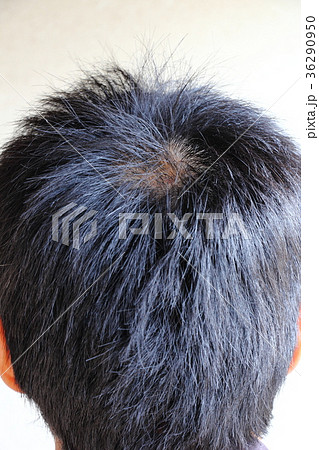 薄くなりはじめた頭頂部 36290950