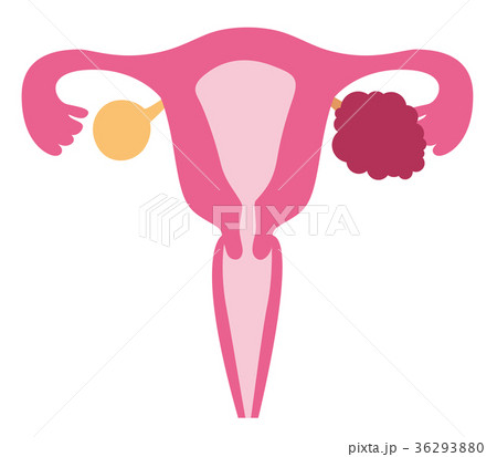 卵巣癌 病気 子宮のイラスト素材