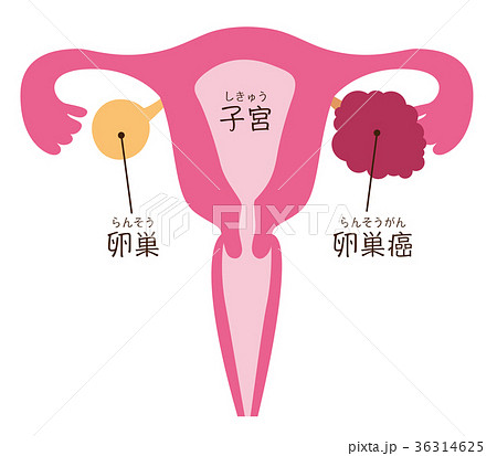 卵巣癌 病気 名称入りのイラスト素材
