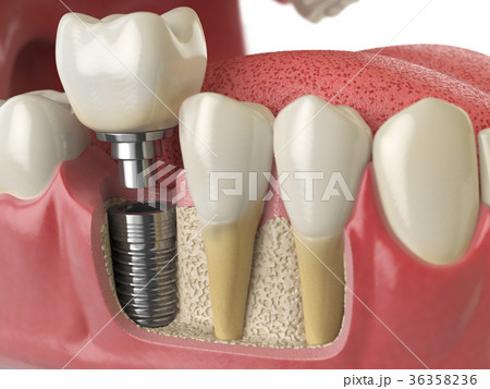 Anatomy healthy teeth and tooth dental implant 36358236