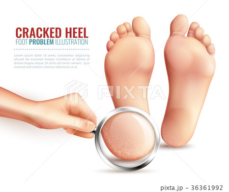 Cracked Heels Illustration 36361992