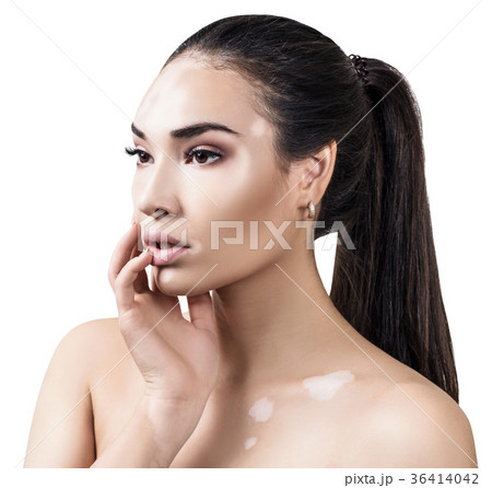 Portrait of beautiful woman with vitiligo. Portrait of beautiful woman with vitiligo. 36414042