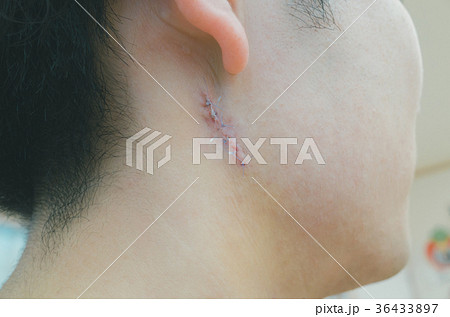 atheroma atheroma 36433897