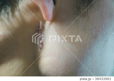 atheroma atheroma 36433901