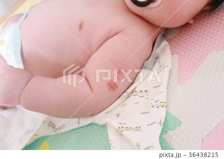 BCG予防接種した赤ちゃんの腕 BCG予防接種した赤ちゃんの腕 36438215