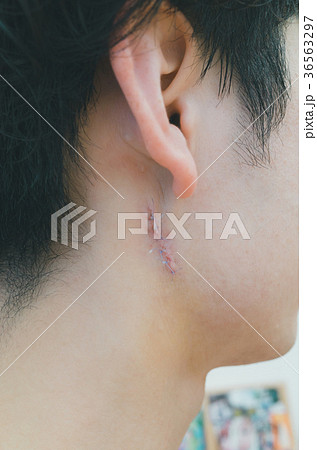 atheroma 36563297