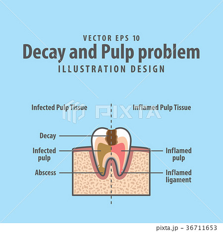Decay and Pulp problem structure of tooth vector 36711653