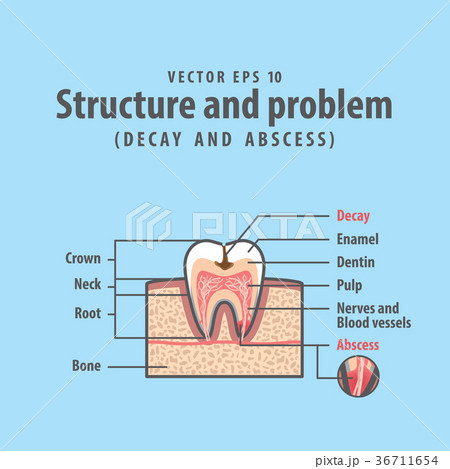 Decay and abscess structure inside tooth vector 36711654