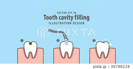 Step of tooth cavity filling illustration vector Step of tooth cavity filling illustration vector 36786228