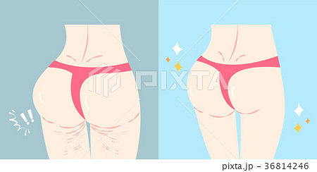 buttocks buttocks with plastic surgery conceptのイラスト素材 [36814246] - PIXTA