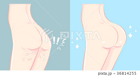 buttocks with plastic surgery concept 36814255