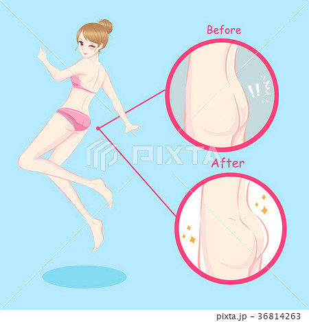 woman with butt implant woman with butt implant 36814263
