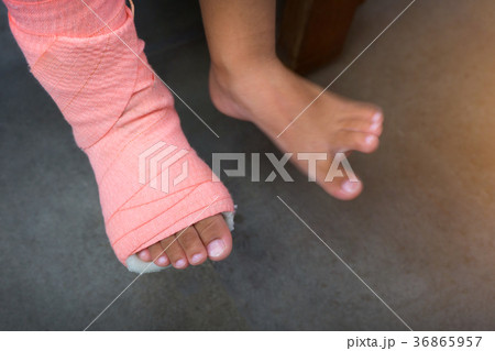 Children wearing a splint of leg broken 36865957