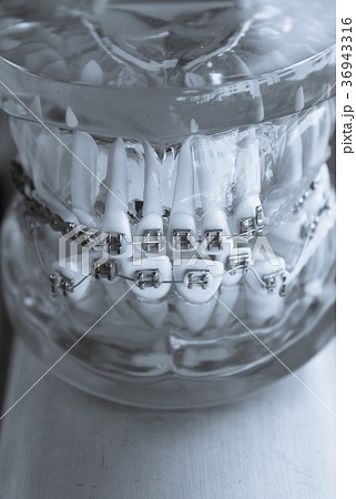 Classic dental metal orthodontics with colored Classic dental metal orthodontics with colored 36943316