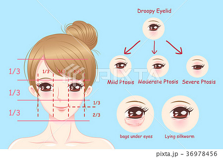 woman with droopy eyelids 36978456